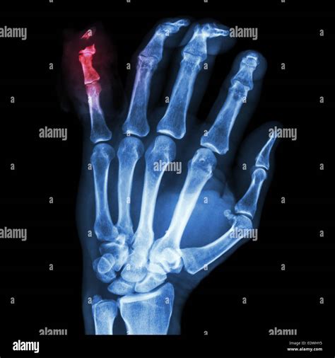 Film X Ray Hand Ap Show Fracture Distal Pharange Little Finger Stock