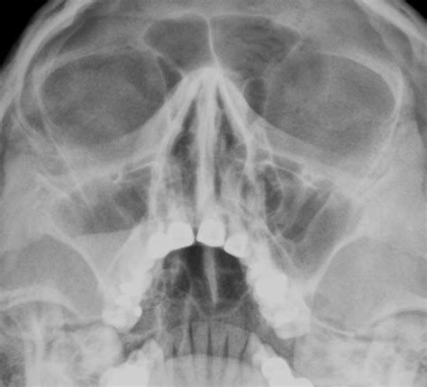 Maxillary Sinusitis X Ray