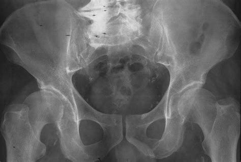 Anteroposterior Radiograph Of The Pelvis And Hips Reveals No Evidence