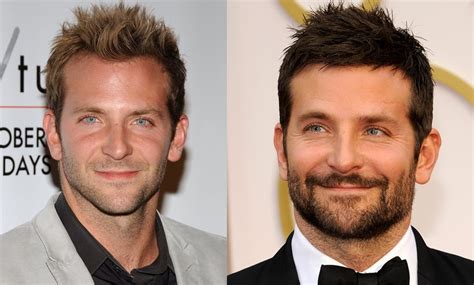 View 5,264 before and after hair transplant photos, submitted by real doctors, to get an idea of the results patients have seen. Has BRADLEY COOPER Had a Hair Transplant? - Top Hair Loss ...