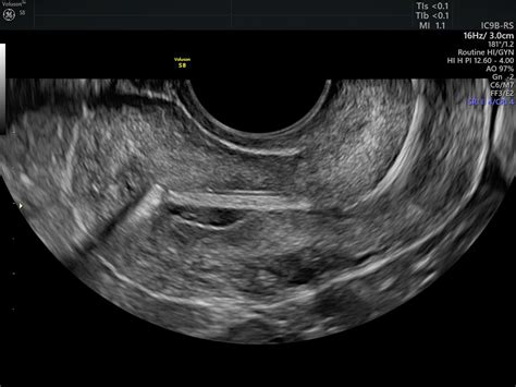 Navigating Copper IUD Placement And The Use Of Ultrasound Empowered Women S Health
