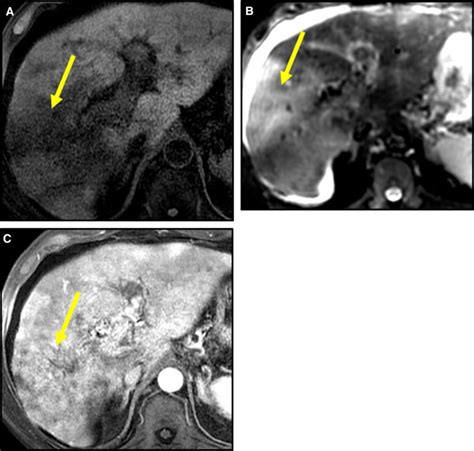 2mri Of The Liver In A Patient With Infiltrative Hcc Yellow Arrows