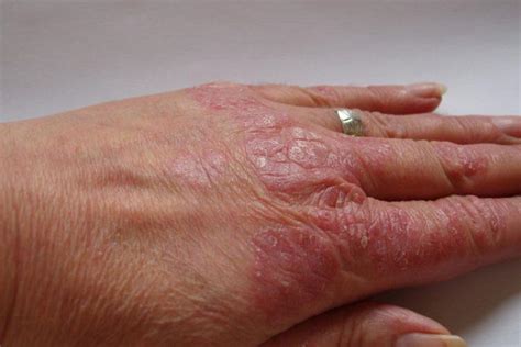 All You Need To Know About Psoriasis Causes Symptoms And Treatments Unp Me