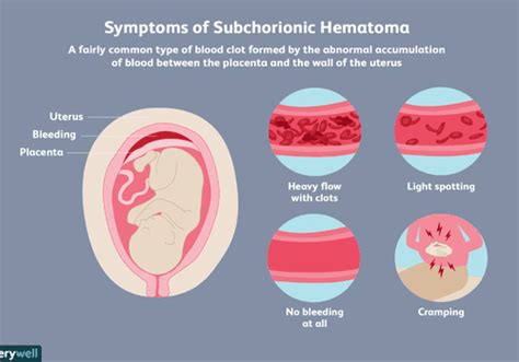 Subchorionic Hematoma และความเสี่ยงในการตั้งครรภ์ Medthai