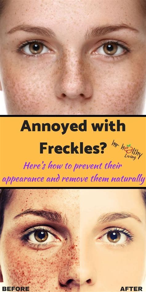 Overcoming Insecurity The Best Ways To Get Rid Of Freckles Justinboey