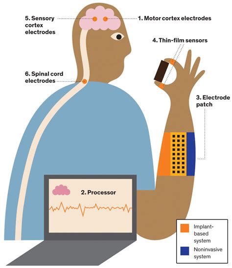 Brain Implants And Wearables Let Paralyzed People Move Again News