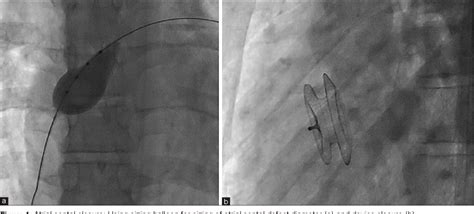 Figure 1 From Midterm Follow Up Results Of Transcatheter Interatrial