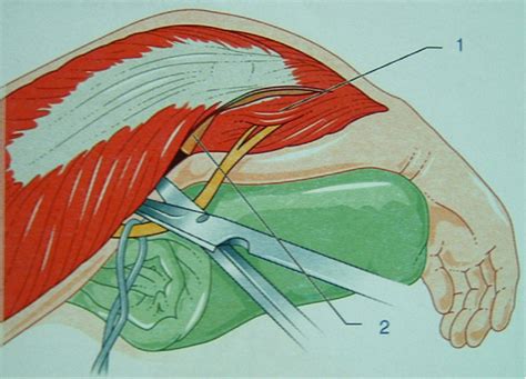Ulnar Nerve Dissection Download Scientific Diagram