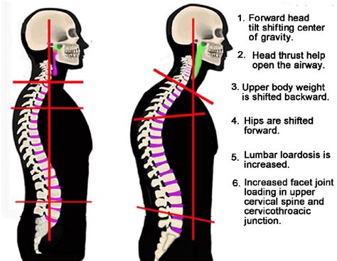 Schematic Drawing Showing The Postural Changes In Sdb And Osa Patients