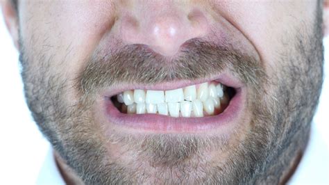 Effects Of Teeth Grinding Bruxism Articles Mark Tangri Dental