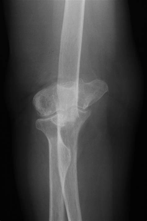 Linked Elbow Replacement A Salvage Procedure For Distal Hum Jbjs
