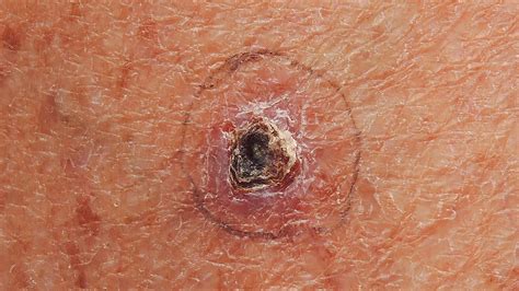Skin Cancer Spots On Back