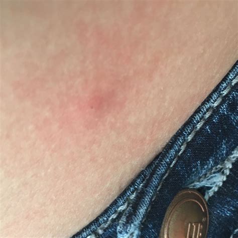 Ein zeckenbiss oder zeckenstich kann zur übertragung einiger krankheiten auf den menschen führen. Zeckenbiss und etwas kleines Schwarzes? (Arzt, Wunde, Zecken)