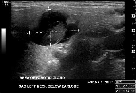 Pathology Outlines Cystadenoma