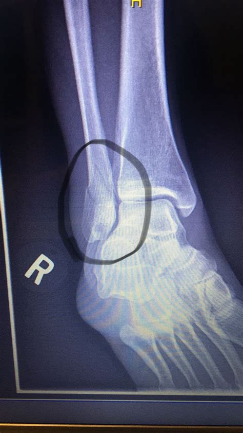 Pin Em Broken Fibula Ankle Fracture