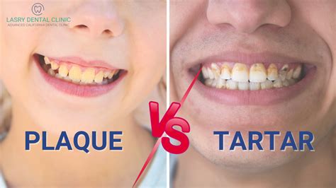 Plaque Vs Tartar And How To Remove Them At Home