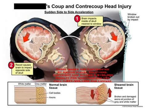 AMICUS Illustration Of Amicus Injury Head Coup Contrecoup Side