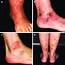 Skin Lesions Relevant For The Differential Diagnosis Of Cutaneous 