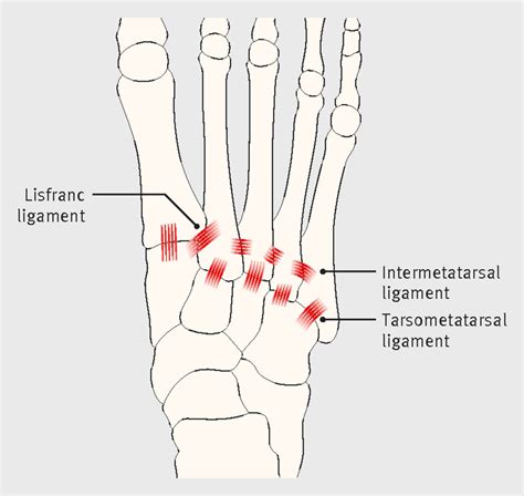 A Painful Foot Lisfranc Fracture Dislocations The Bmj