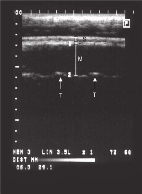 Longitudinal Ultrasound Image Between The 3rd And 4th Lumbar Vertebrae