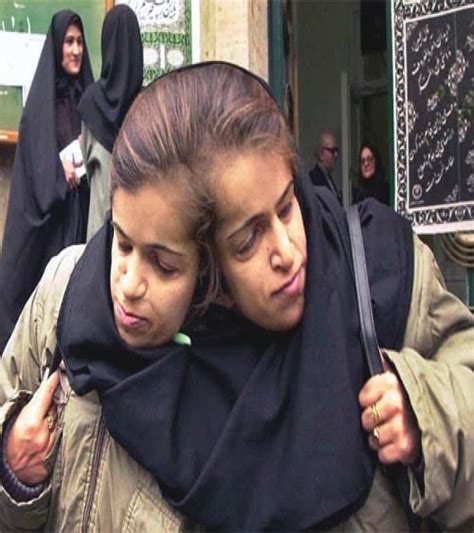 Ladan bijani and laleh bijani (in persian: 12 Insane Photos Of Conjoined Twins