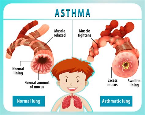 Asthma Diagram With Normal Lung And Asthmatic Lung 3303538 Vector Art