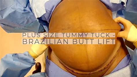 Plus Size Tummy Tuck And Brazilian Butt Lift Dr Remus Repta Youtube