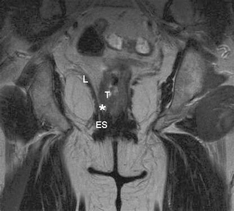 Preoperative Staging Of Rectal Cancer With Mr Imaging Correlation With