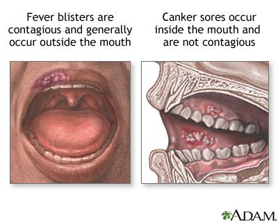 On your tongue, on your soft palate (the back portion of the roof pain from a canker sore tends to get better in a few days, and the sores usually heal without. Mouth sores | UF Health, University of Florida Health