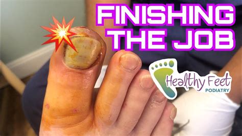 Removing The Rest Of A Lifted Toenail Youtube