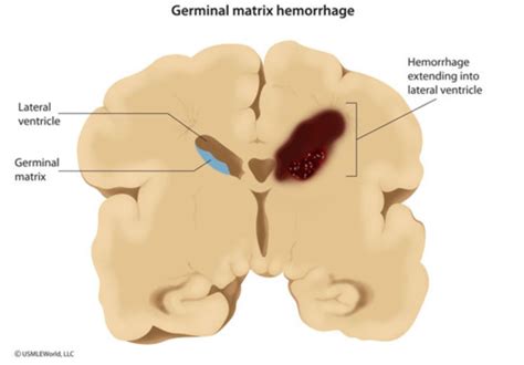 Germinal Matrix Brain Anatomy