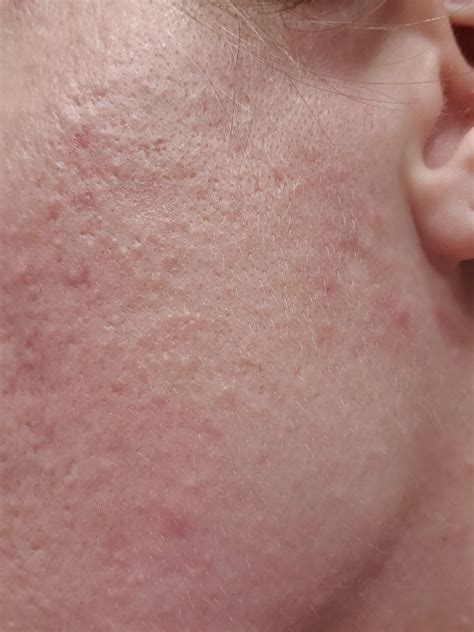 Help Tiny Bumps On Jawline And Cheek Tretinoin Images