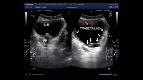 Ultrasound Video Showing Trabeculated Bladder And Enlarged Prostate