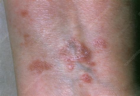 Lichenoid Rash Due To Drug Reaction Stock Image M3200176 Science