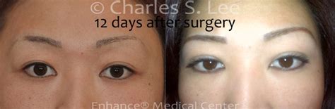 Incision Eyelid Surgery Charles S Lee Md