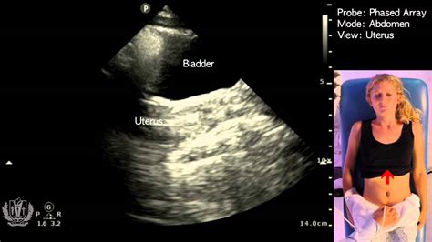 Normal Female Anatomy And How It Is Seen On An Ultrasound