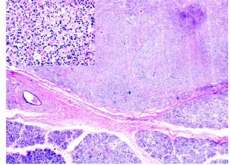 Diffuse Macrophagic Pattern Observed In The Intraparotid Lymph Node