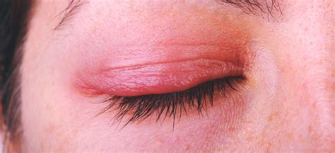 Macro Woman S Eye Swollen Inflamed Eyelid Symptom Stock Photo By