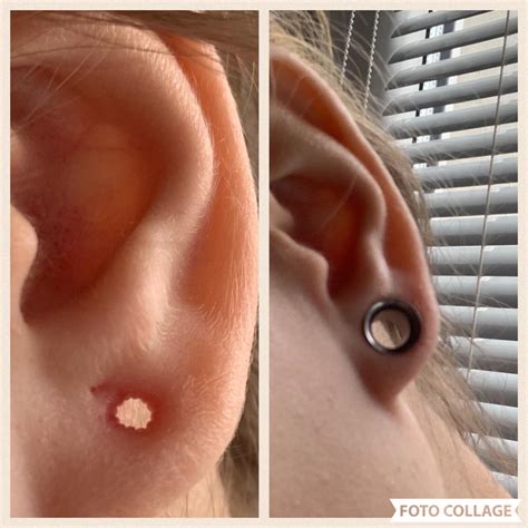What Do Healthy Stretched Ears Look Like