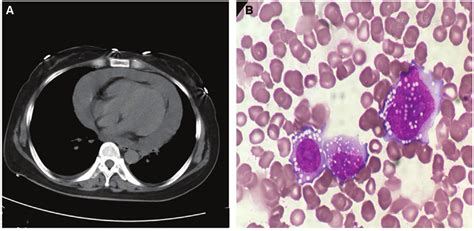 Acute Myeloid Leukemia Relapse After Allogeneic Hematopoietic Stem Cell