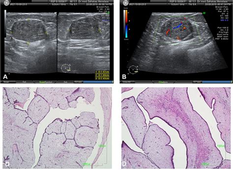 Mixed Fibroadenoma And Phyllodes Breast Tumor Limitations Of Core