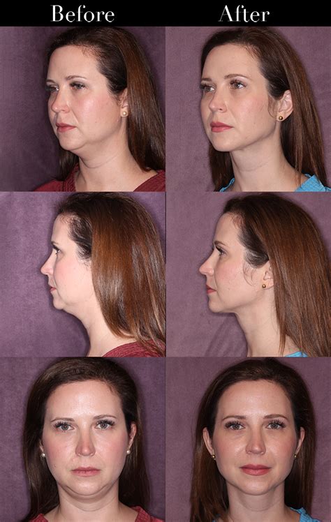 How To Make Jawline More Defined With Makeup