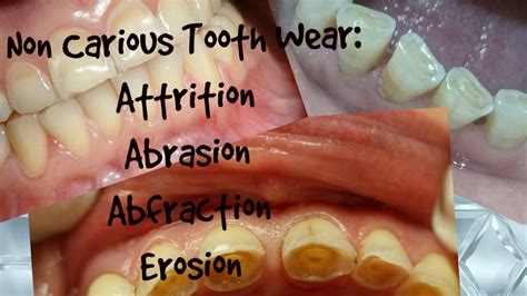 This is caused by the flexing of the tooth. Abfraction Tooth Abrasion - The Engineering Internship ...
