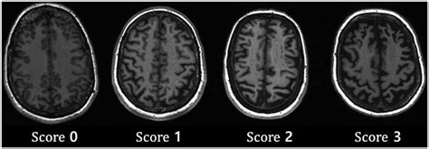 알츠하이머병 환자의 뇌 영상 검사의 최신 지견과 임상 적용 방법