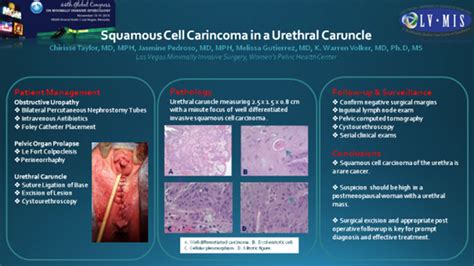 Squamous Cell Carcinoma In A Urethral Caruncle Journal Of Minimally