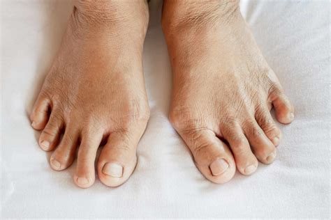 Psoriatic Arthritis Feet Online Discounts Save 52 Jlcatj Gob Mx