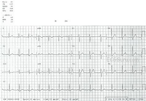 Heartbeat Normal Ecg Graph Stock Illustration Illustr