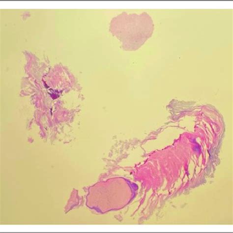 Histologic Section Showing Cartilaginous Choristoma Mass Shows Focal