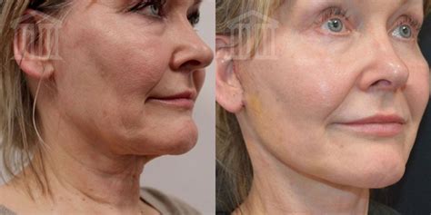 Facelift Surgery Zenith Cosmetic Clinics