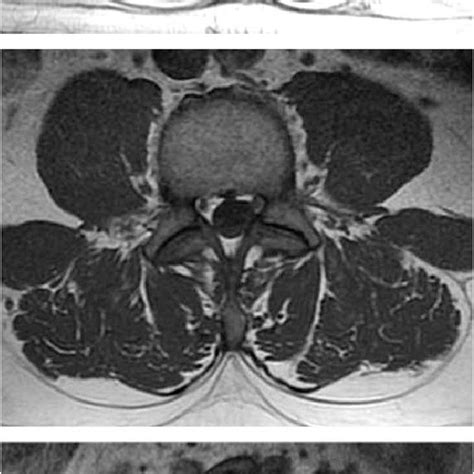 Examples Of T1 Weighted Mri Images Of Lumbar Spine At L3 Showing Mild